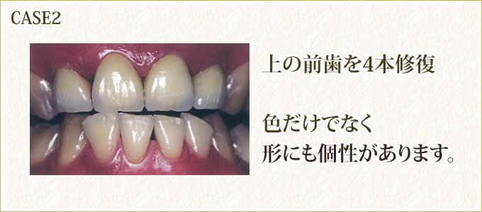 CASE2 上の前歯を4本修復 色だけでなく形にも個性があります。